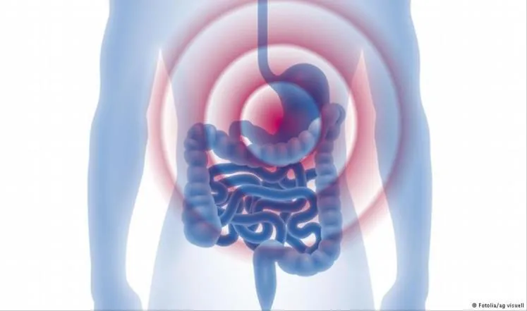 قد يؤدي الارتجاع المريئي المزمن إلى التهاب المريء والسرطان (دويتشه ف